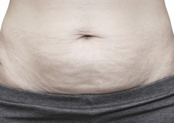 Por qué se produce la flacidez, cómo prevenirla y cómo tratarla?